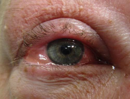 Sindrome di Reiter, quali sono i sintomi?